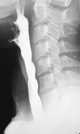 Barium swallow | Radiology Reference Article | Radiopaedia.org