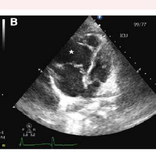 Admission transthoracic echocardiogram (TTE): (A) parasternal short ...