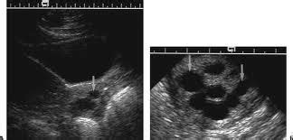 WK 3 L 2 Nabothian Cyst (Image only) | OB/Gyn Ultrasound 101 Mod 2 | Ultrasound