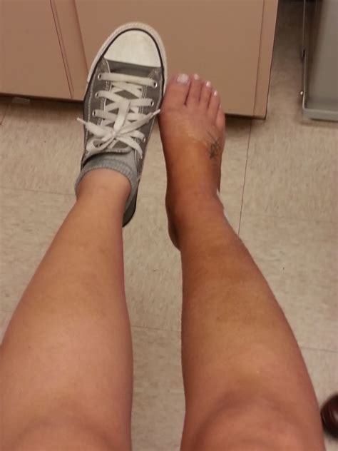 My Broken Ankle =(: Cast Removal Day!