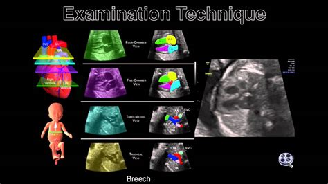 The Fetal Heart-The Transverse Sweep - YouTube