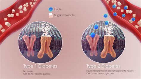 Does Prediabetes mean that you'll get Diabetes? - Scientific Animations