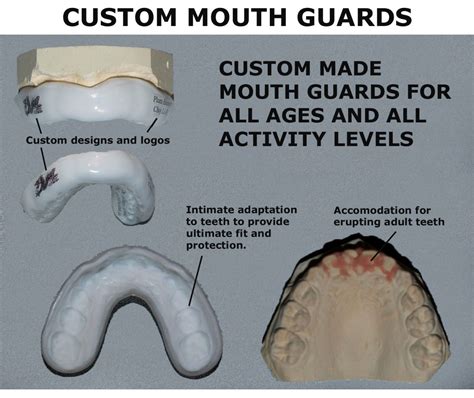 Custom Mouthguards | My Family Dentist