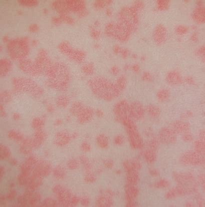 Gallery For > Mononucleosis Rash