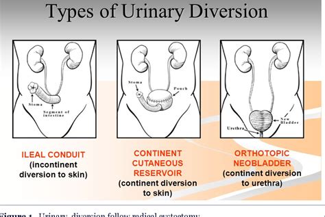 Figure 1 from Application of Alvimopan as a Component of Enhanced Recovery After Surgery (ERAS ...