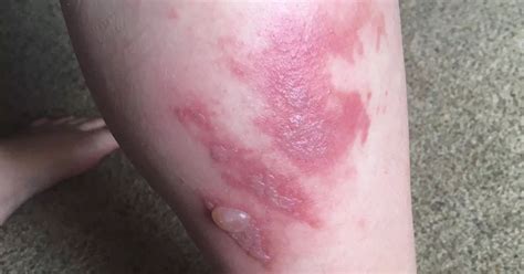 Giant Hogweed warning: Pharmacist reveals how to treat severe burns and blisters caused by plant ...