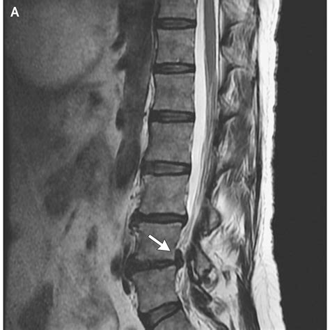 Sciatica Pain Relief Part 2: Common Causes of Sciatica — Revive Sport & Spine