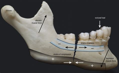 Treatment Of Mandibular Fractures By Means Of Compres - vrogue.co