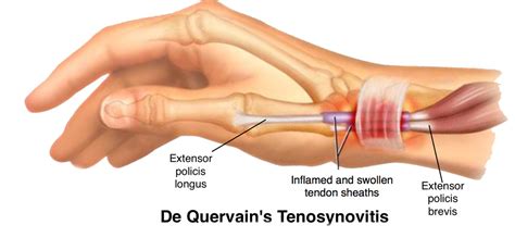 De Quervain’s Tenosynovitis Treatment | Pushp Hospital Nashik