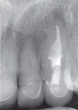 Six-month follow-up radiograph of the maxillary left canine showing ...