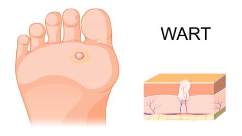 How to Get Rid of Plantar Warts in Most Effective Ways | Skin Cancer ...