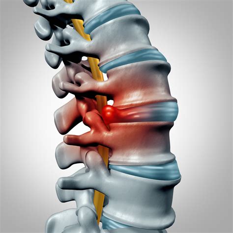 Bulging Disc Disorder & Treatment NJ | North Jersey Spine Group