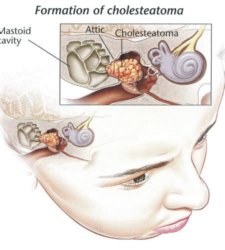 Mastoidectomy or tympanoplasty - Dr Bridget Clancy | ENT Surgeon