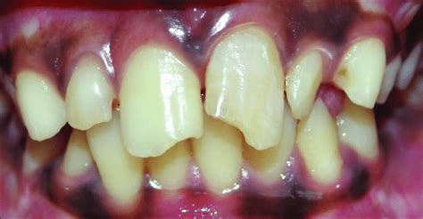 Intraoral photograph showing Ellis Class II fracture with respect to 11... | Download Scientific ...