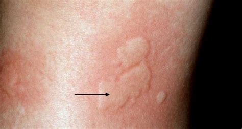 WHEAL Primary SKIN LESION black arrow. | Ophthalmic Technician