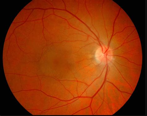 What is Central Serous Retinopathy | Fort Lauderdale Eye Institute