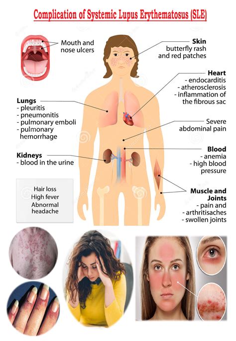 Systemic Lupus Erythematosus (SLE) - MedicoInfo