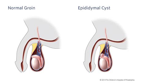 Epididymal Cyst and Spermatocele | Children's Hospital of Philadelphia