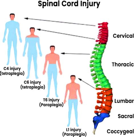 Quadriplegia Tetraplegia Definition Causes Symptoms