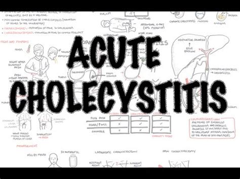 Acute Cholecystitis - Overview (signs and symptoms, pathophysiology, treatment) - YouTube