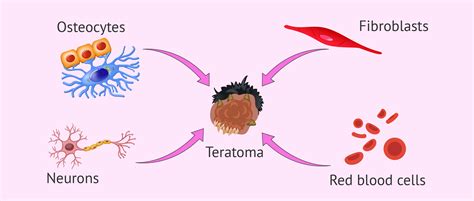 Ovarian Teratoma - Can It Contain Teeth, Hair & Other Organs?