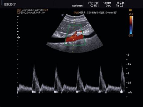 Ultrasound images • Celiac artery, CFM & PW, echogramm №494