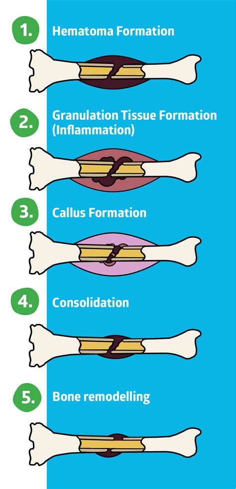 Bone Fracture Hematoma at John Hilton blog