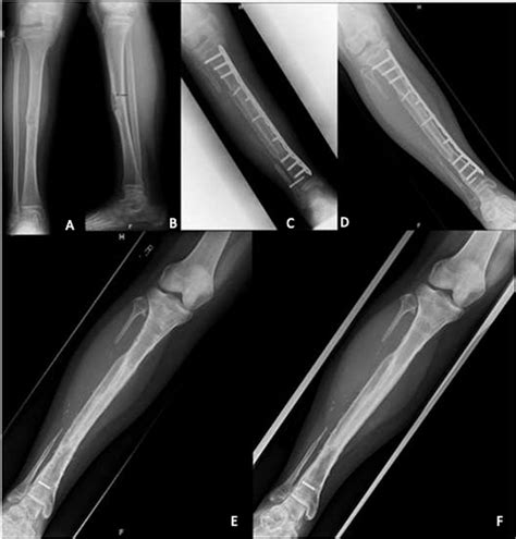 Vascularized Bone Graft Reconstruction Following Bone Tumor Resection ...