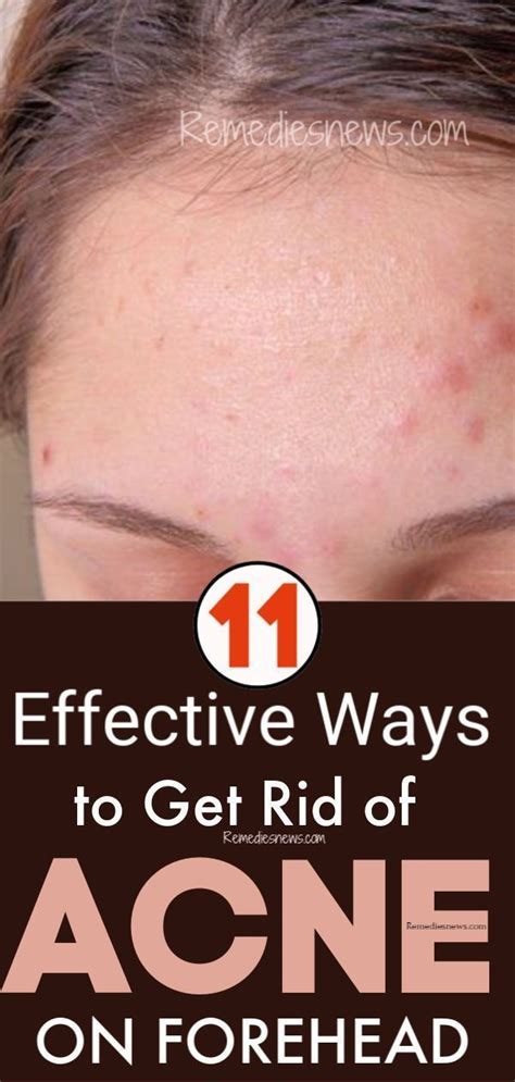 How to Get Rid of Acne on Forehead Overnight-11 Effective Acne Remedies # ...