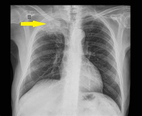 Pancoast tumor chest x ray - wikidoc