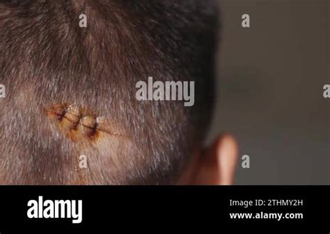 The lacerated sutured wound of kid back head which suture by nylon suture about 3 stitches at ...