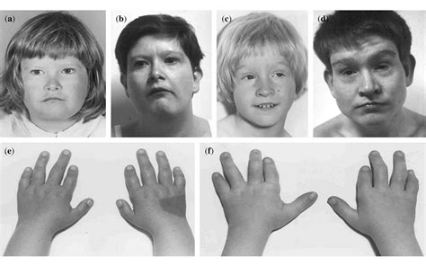 Figure 1 from Drayer's syndrome of mental retardation, microcephaly ...