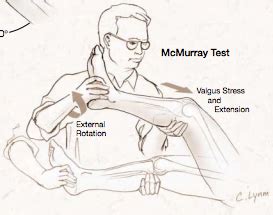 I Kneed You – The Thessaly Test for Meniscal Injury - CanadiEM