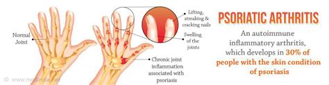 Psoriasis and Psoriatic Arthritis Can Occur Together - Quick Facts ...