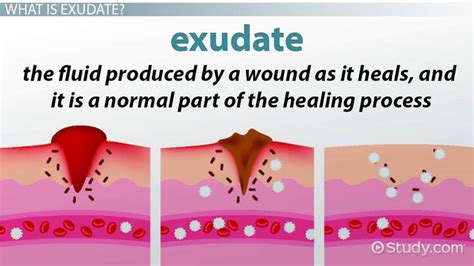 Exudate: Definition & Types - Lesson | Study.com