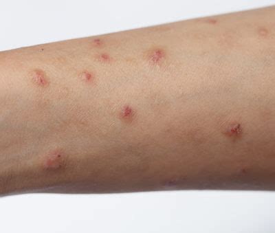 Picato Gel Side Effects Linked To Shingles, Severe Allergic Reactions: FDA Warns - AboutLawsuits.com