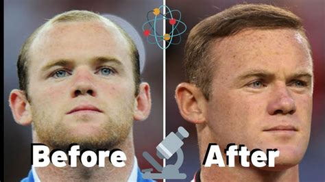 Wayne Rooney Hair Transplant - What Happened?! | Hair transplant, Going ...