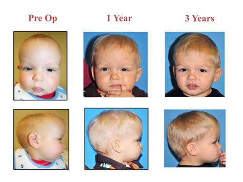 Sagittal Craniosynostosis