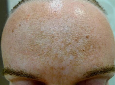 Melasma causes, symptoms, diagnosis & best treatment for melasma on face