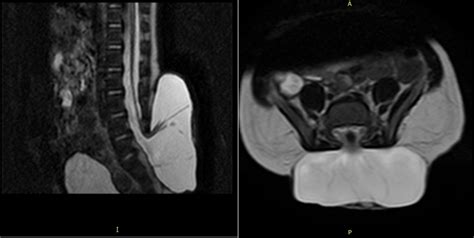 Spina Bifida Mri