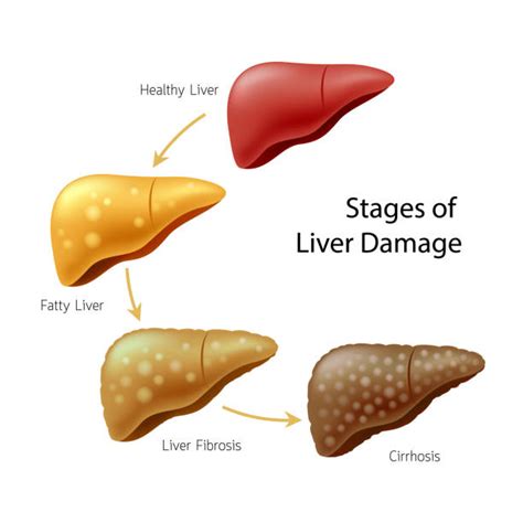 Liver Cirrhosis Illustrations, Royalty-Free Vector Graphics & Clip Art ...