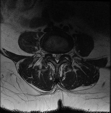 Synovial Facet Cyst - Spine - Orthobullets