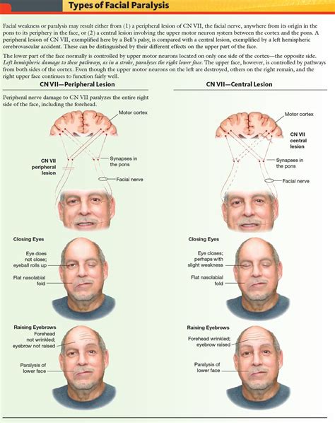 Peripheral Facial Nerve Palsy | Images and Photos finder