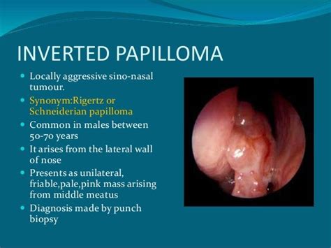 Sinus Opacification - JanetthtyuiMarhtyus