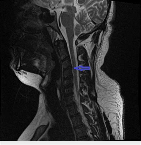 Magnetic Resonance Imaging (MRI) of the cervical spinal cord Sagittal... | Download Scientific ...