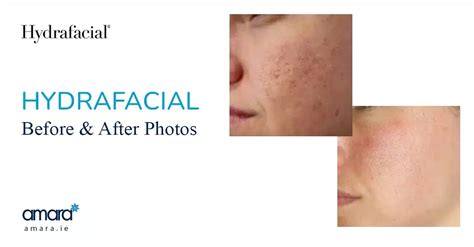 Hydrafacial Before and After Photos | Amara Skincare Dublin