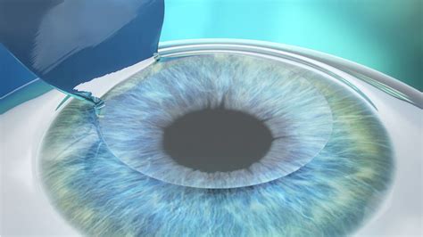 Comparing LASIK Technologies: Wavefront LASIK vs. Contoura Vision in ...