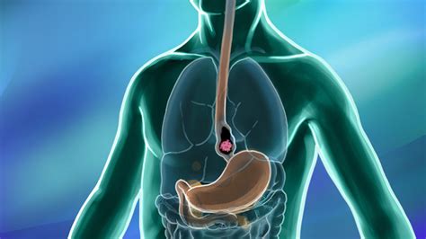 Esophageal Cancer: Causes, Symptoms & Treatment Options