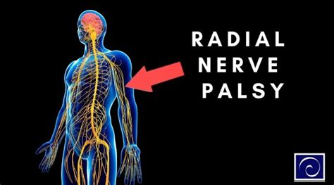 Radial Nerve Palsy ~ Centeno-Schultz Clinic