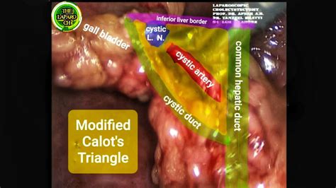 Laparoscopic Cholecystectomy (Short Cystic & Fat Leyden Gall Bladder ...